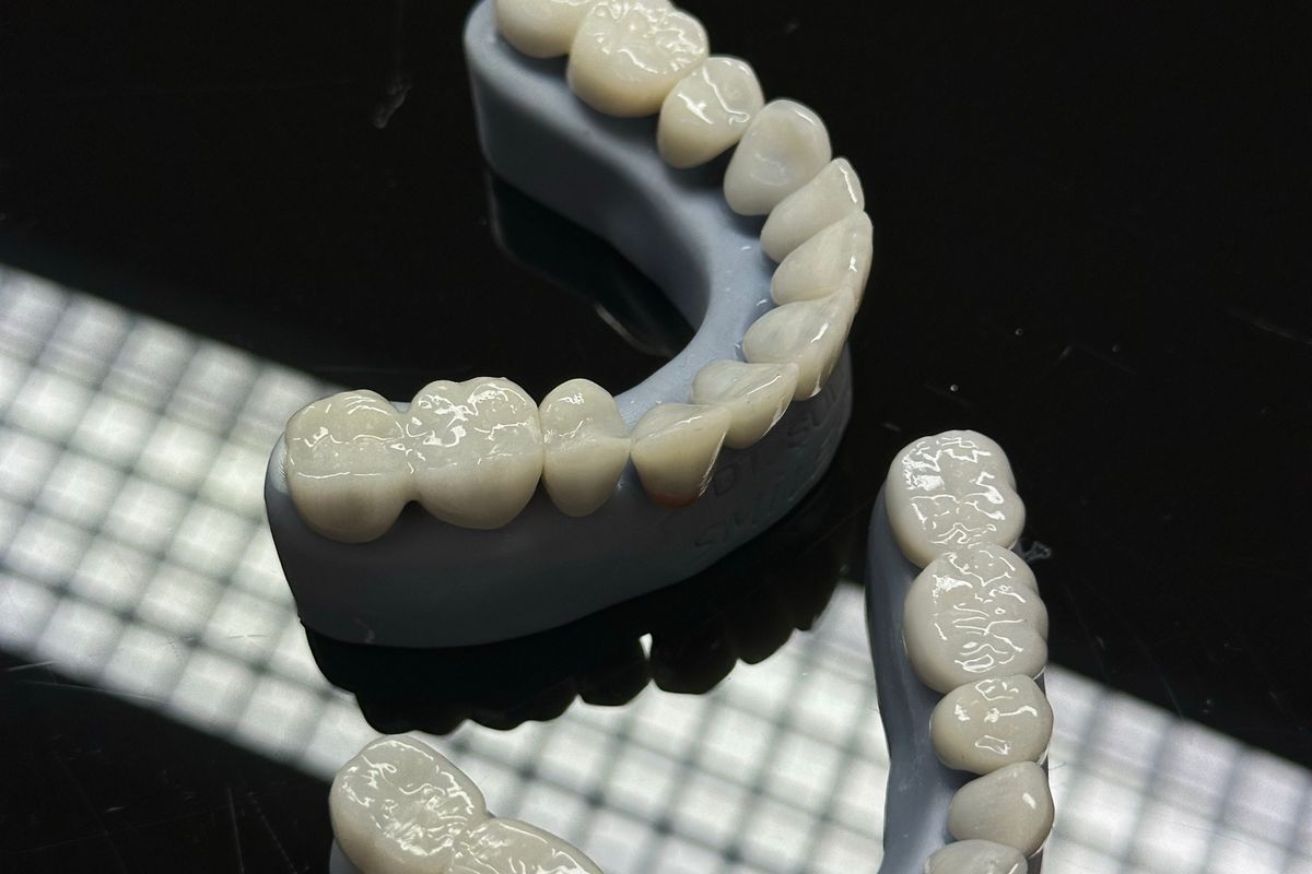 Corona dental de cerámica fabricada con CAD/CAM, lista para cementar