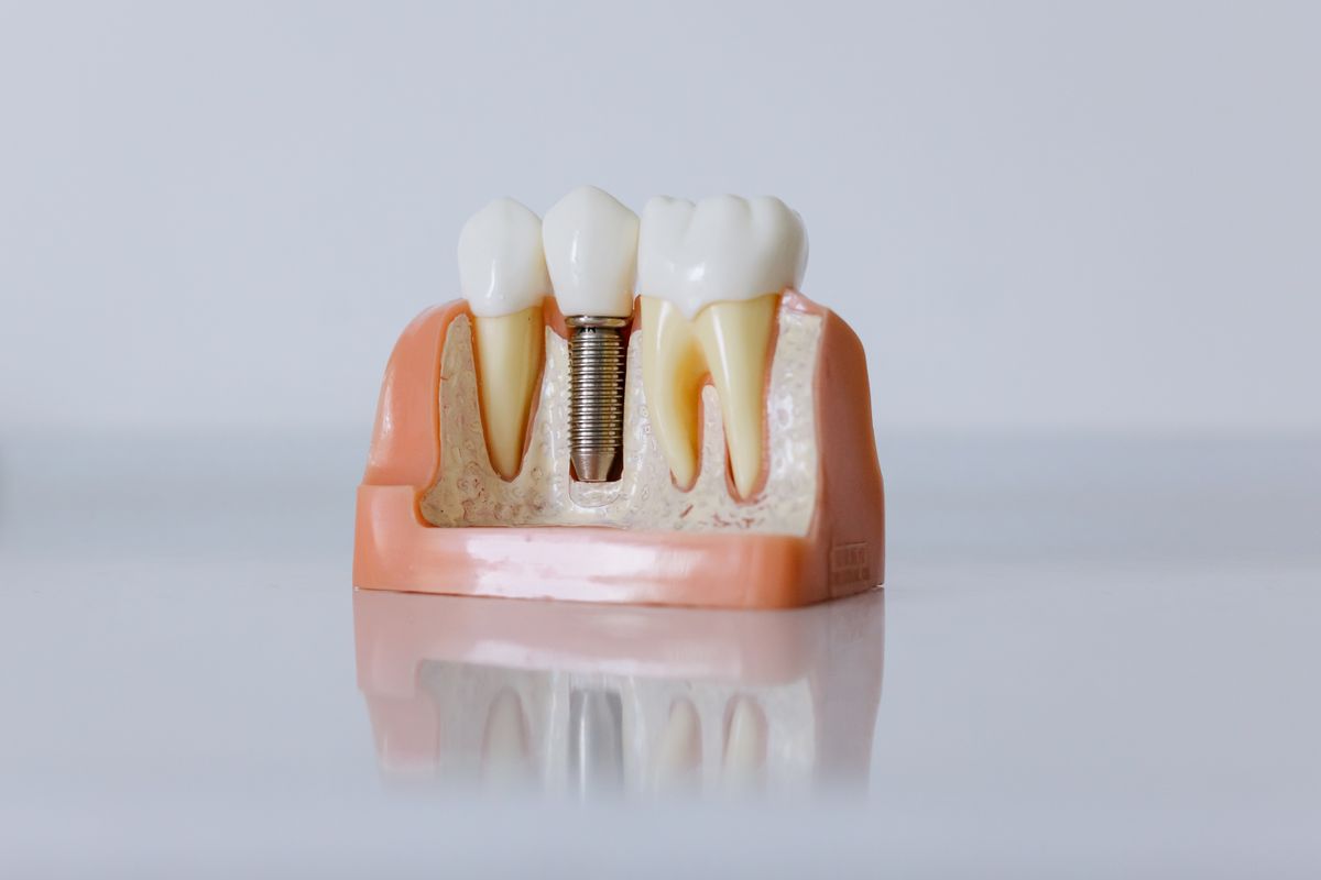 Modelo en sección de un implante dental integrado en el hueso, base del éxito a largo plazo
