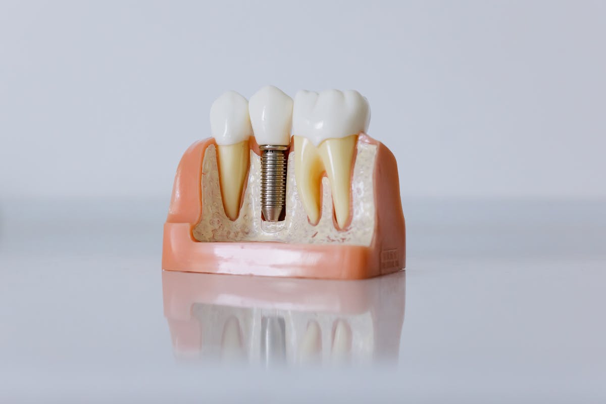 Modelo de implante dental con corona que ilustra la prótesis fija colocada el mismo día