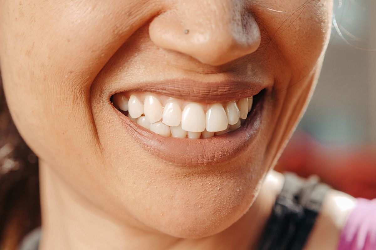 Sonrisa natural y armónica como resultado de un diseño de sonrisa digital