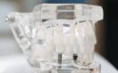 Fracaso implantes prevencion