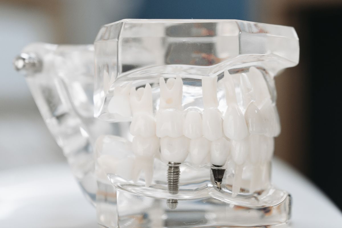 Fracaso implantes prevencion