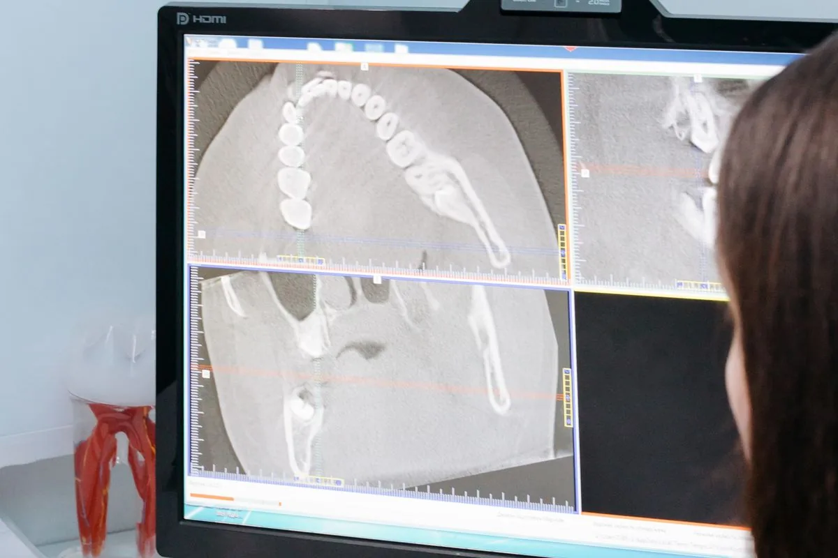 CBCT dental en pantalla para planificar una reendodoncia o una cirugía de la raíz