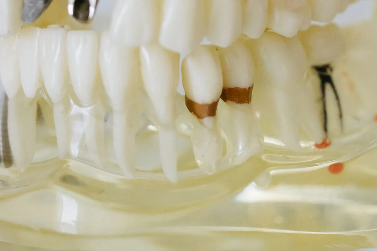 Modelo dental transparente con infección en la punta de la raíz, origen de la fístula y del bulto en la encía