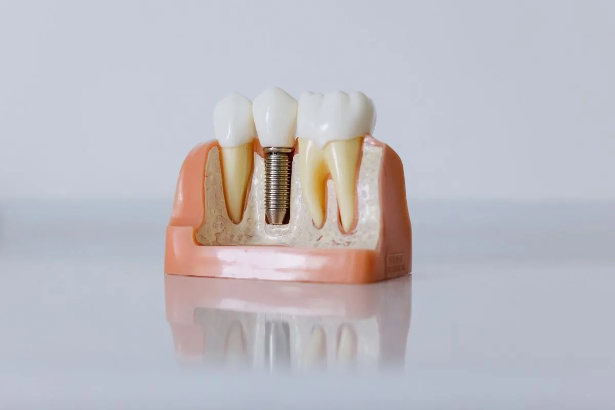 Modelo de implante dental para sustituir un diente con infección en la raíz que no se puede salvar