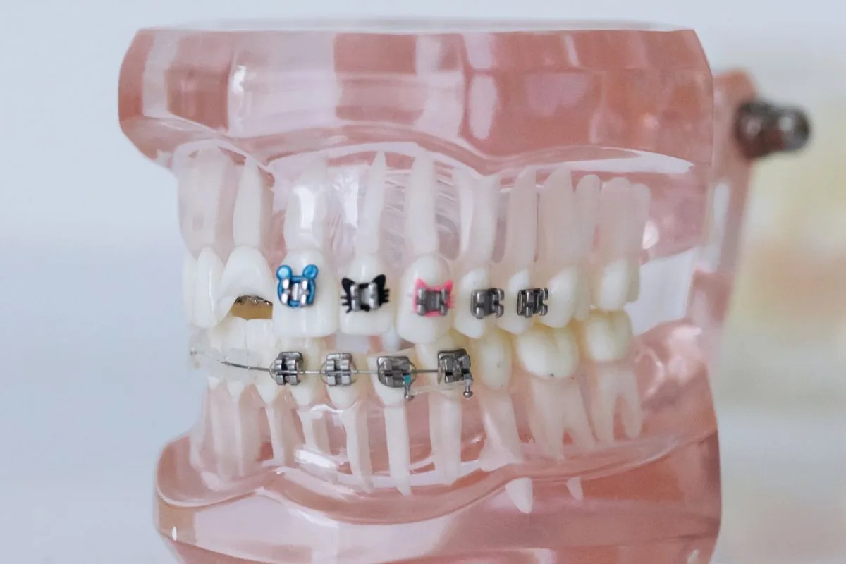 Modelo dental con brackets y arco metálico que muestra por qué duelen los dientes con brackets al moverse