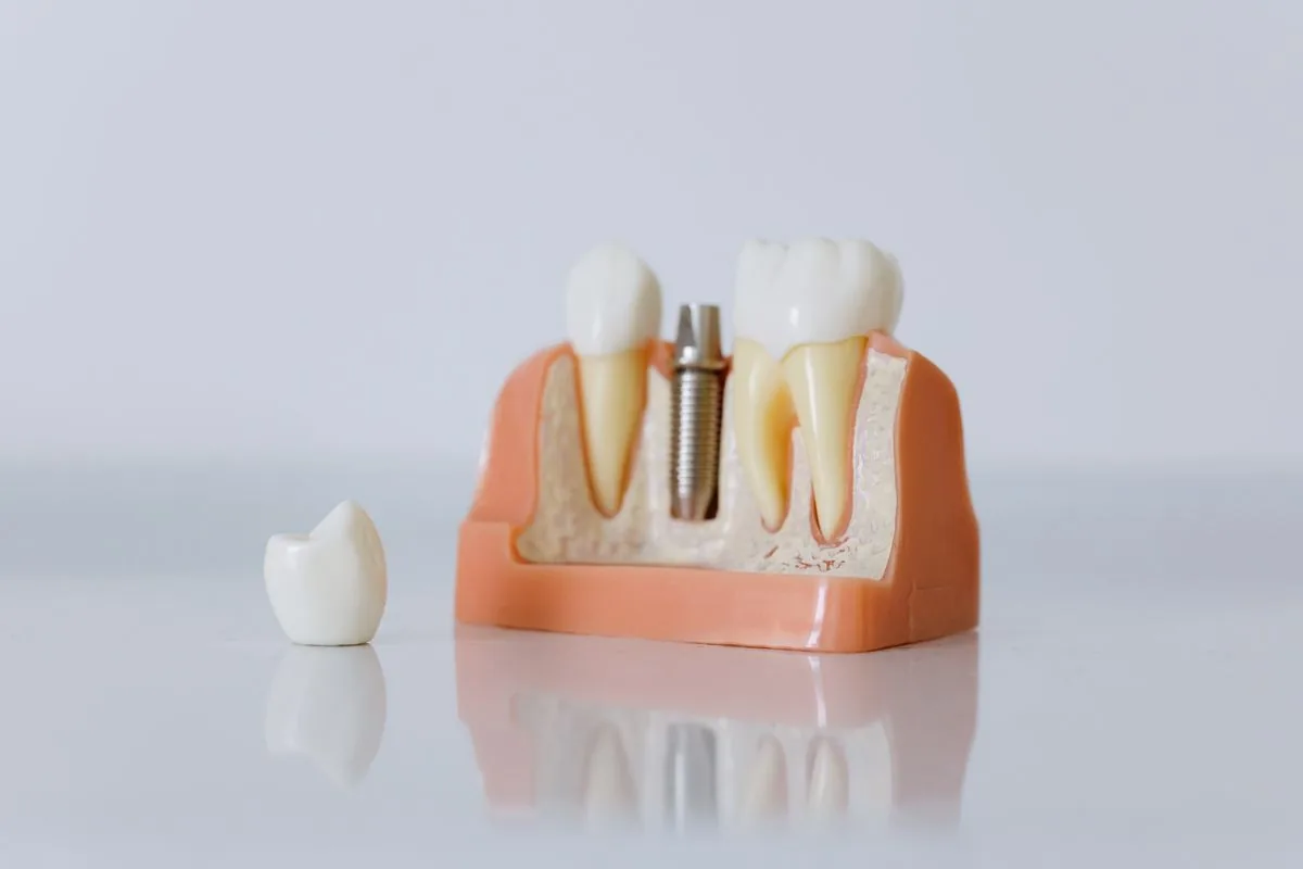 Implante dental con corona que respeta los dientes vecinos, frente al puente que obliga a tallarlos