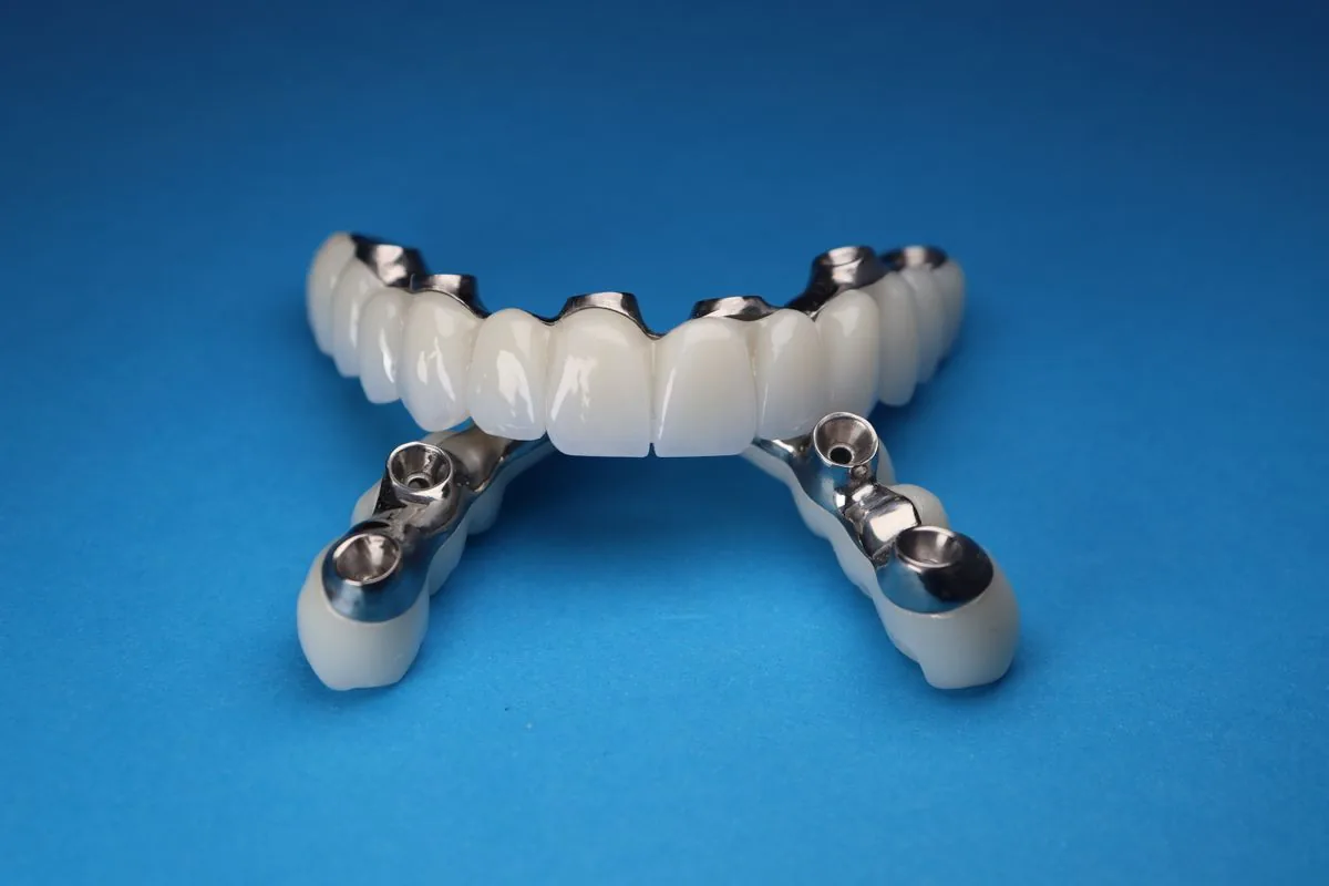 Puente dental sobre implantes para reponer varios dientes sin tallar dientes naturales