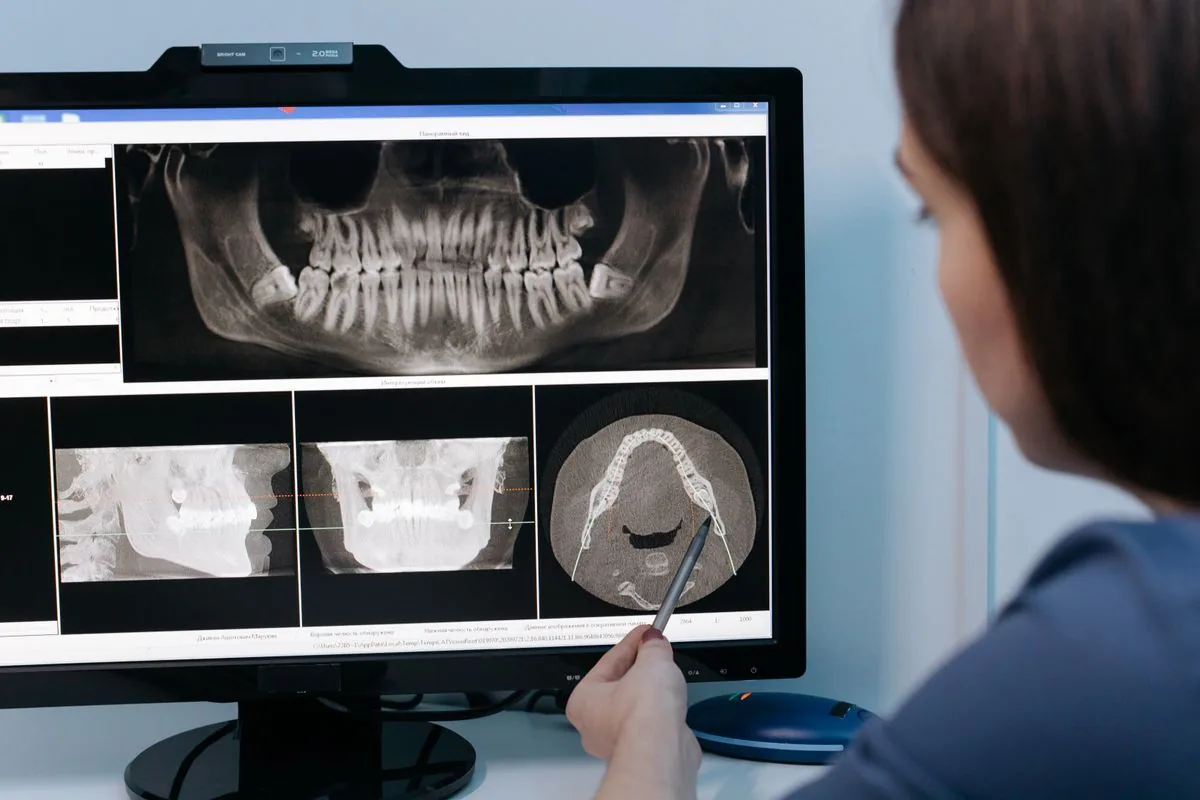 Revisión de la radiografía y el TAC dental para medir el hueso alrededor de un implante con periimplantitis