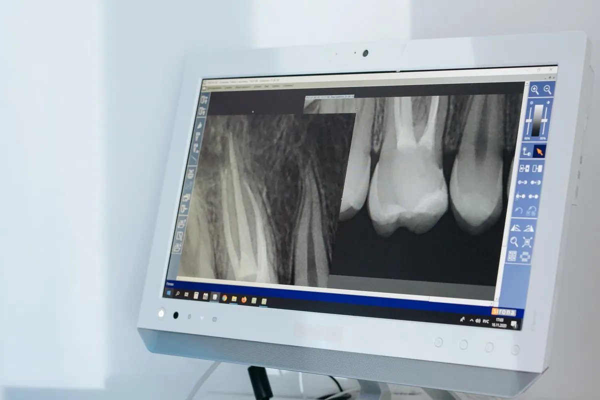 Radiografía periapical de dientes endodonciados para valorar una infección en la raíz