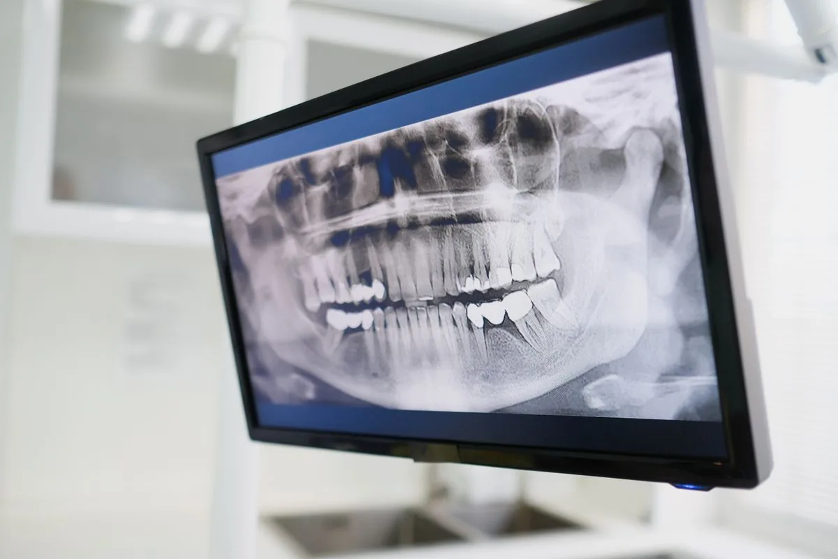 Radiografía panorámica en pantalla para buscar signos de una muela del juicio cerca del nervio dentario